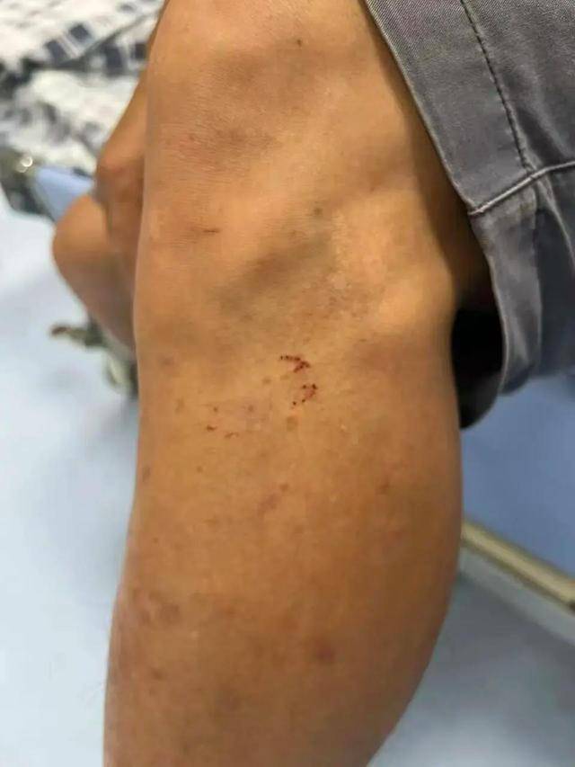 皇冠信用網登123出租_广东62岁阿叔网鱼网到2条眼镜蛇皇冠信用網登123出租,被咬伤后当场打死,并打包提进医院